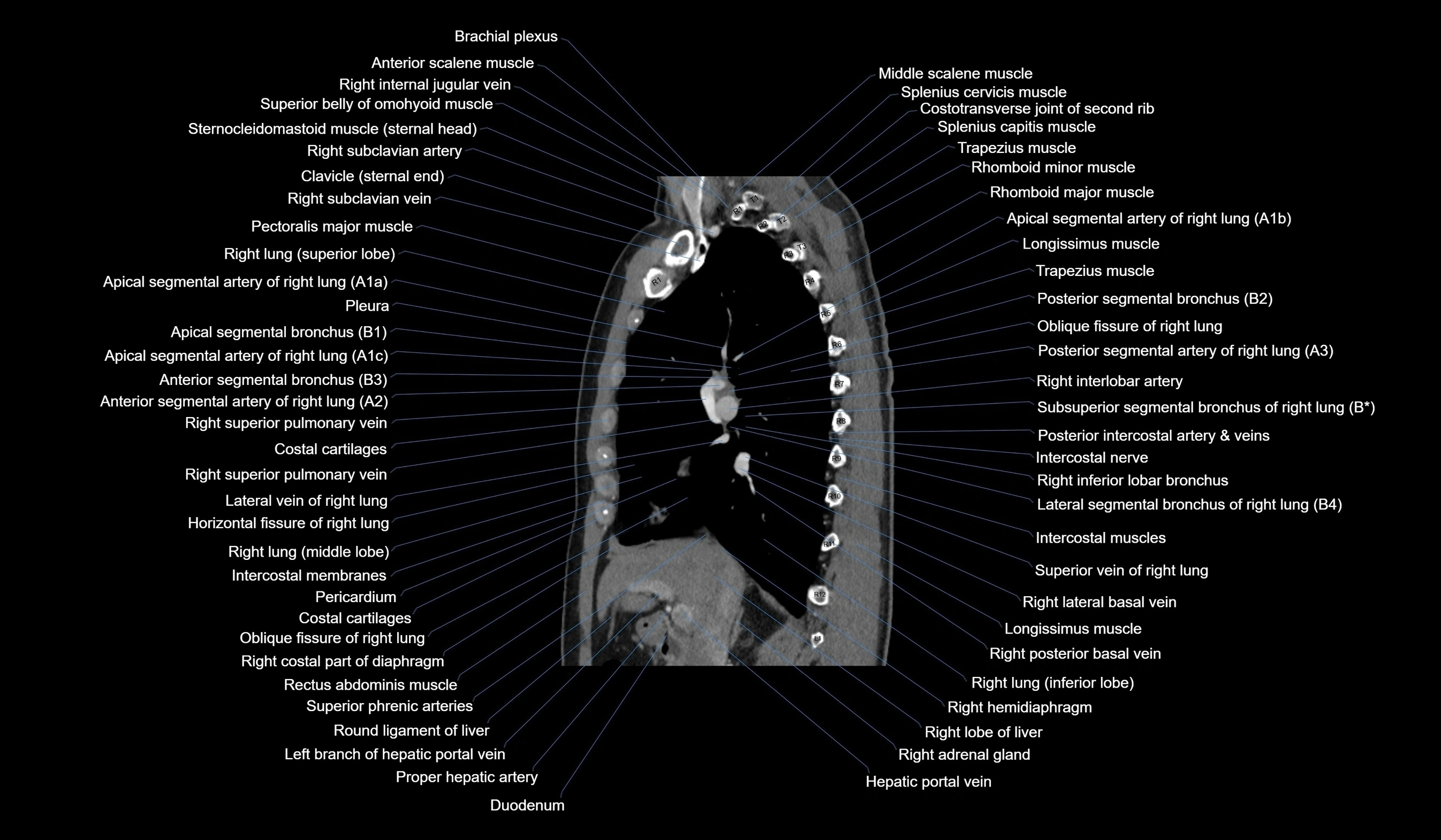 CT chest (thorax) soft tissue window labelled sagittal cross sectional anatomy radiology image-00059.webp